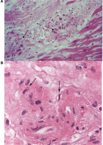 acute-rheumatic-myocarditis