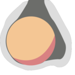 adenoma-pituitary-gland-disorders