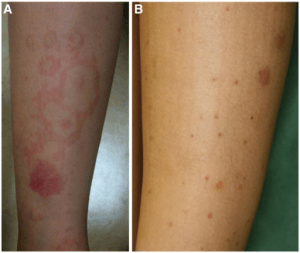 allergic-Purpura
