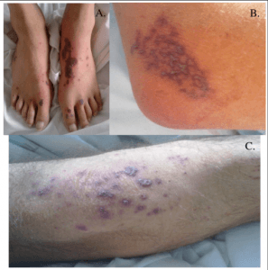 allergic-Purpura2