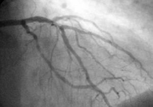 angiogram