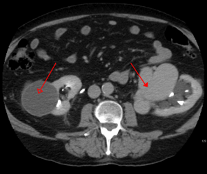 aterial venous malformation of the left kidney