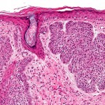 High magnification micrograph of a basal cell carcinoma High magnification micrograph of a basal cell carcinoma