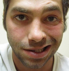 image of man with bells palsy