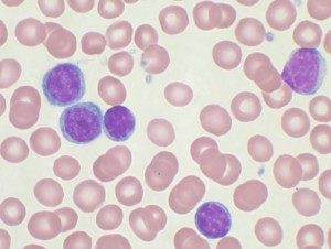 Image: "Blood smear in CLL" by VashiDonsk at the English language Wikipedia. Licence: CC BY-SA 3.0