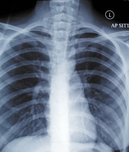 boerhaave syndrome boerhaave syndrome