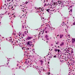 Bone marrow biopsy increased megakaryocytes Bone marrow biopsy increased megakaryocytes