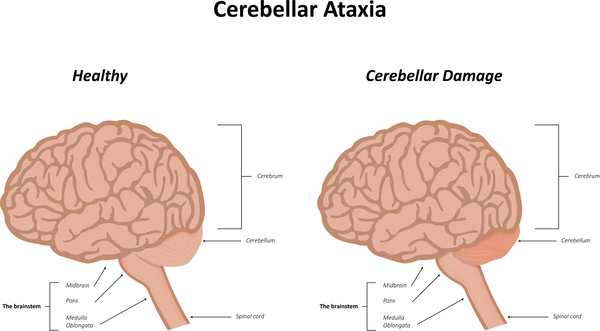 ataxia-in-childhood-symptoms-and-treatment-medical-library