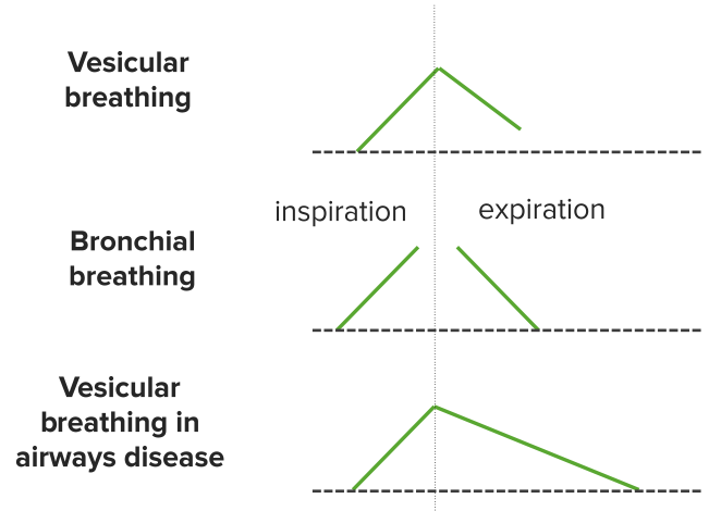 pulmonary edema lung sounds