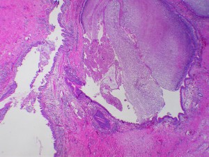 bronchiectasis with aspergilloma bronchiectasis with aspergilloma