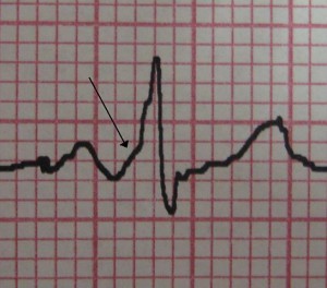 characteristic delta wave seen in a patient with WPW characteristic delta wave seen in a patient with WPW