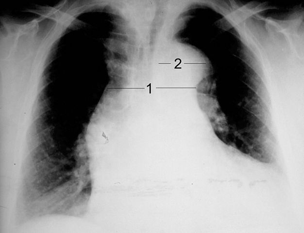 chest x-ray of aortic dissection type Stanford A