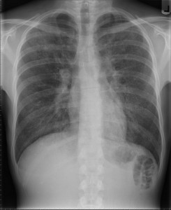 chest x-ray pneumonia chest x-ray pneumonia