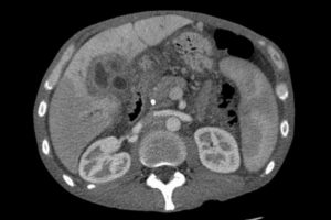 cholangiocarcinoma