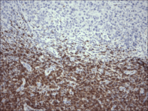 Restricted expression of Bcl-2 within the lymphocytes in chronic lymphocytic leukemia in contrast to malignant melanoma cells Restricted expression of Bcl-2 within the lymphocytes in chronic lymphocytic leukemia in contrast to malignant melanoma cells