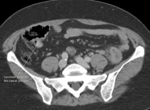 colon cancer CT scan