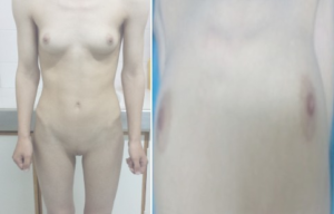 complete-androgen-insensitivity-syndrome
