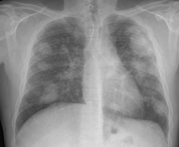 complicated silicosis