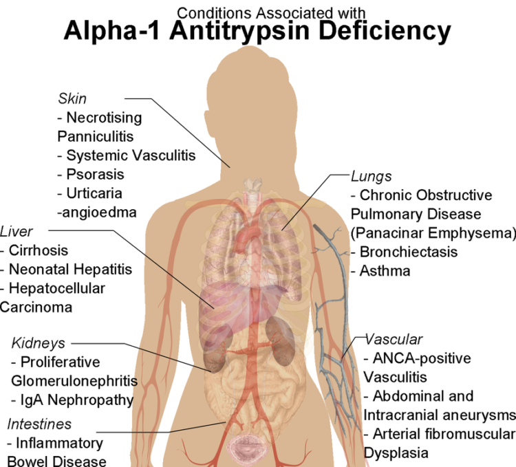 l conditions associated with Alpha-1 Antitrypsin Deficiency