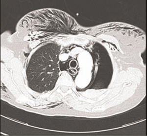 CT study showing extensive subcutaneous emphysema and left-sided pneumothorax, but no demonstration of the esophageal defect CT study showing extensive subcutaneous emphysema and left-sided pneumothorax, but no demonstration of the esophageal defect
