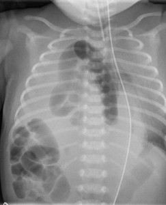 Congenital right sided diaphragmatic hernia in a neonate, Chest X-ray