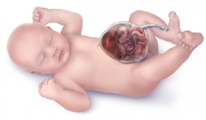 Omphalocele-drawing” by Centers for Disease Control and Prevention