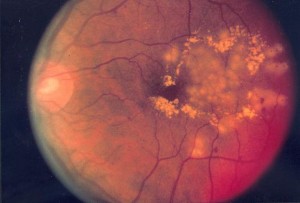 diabetic_retinopathy