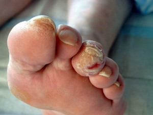 diabetischen foot syndrom