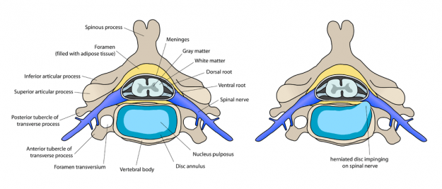 diagram of preconditions for Anterior cervical discectomy and fusion