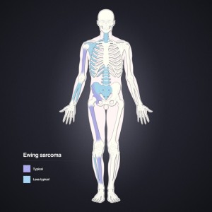 Distribution of Ewing sarcoma Distribution of Ewing sarcoma