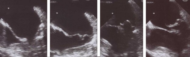 Mitral Valve Prolapse (Barlow Syndrome) — Diagnosis and Treatment