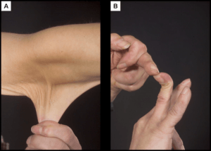 ehlers-danlos syndrome