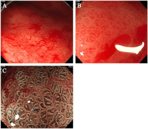 gastrointestinal bleeding