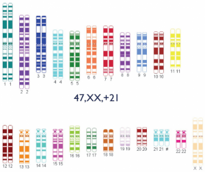 genetic pattern of trisomy 21 genetic pattern of trisomy 21