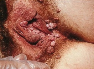 genital warts