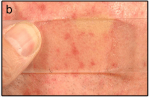 Diascopy of the cheek of a 57-year-old man treated with bosentan Diascopy of the cheek of a 57-year-old man treated with bosentan