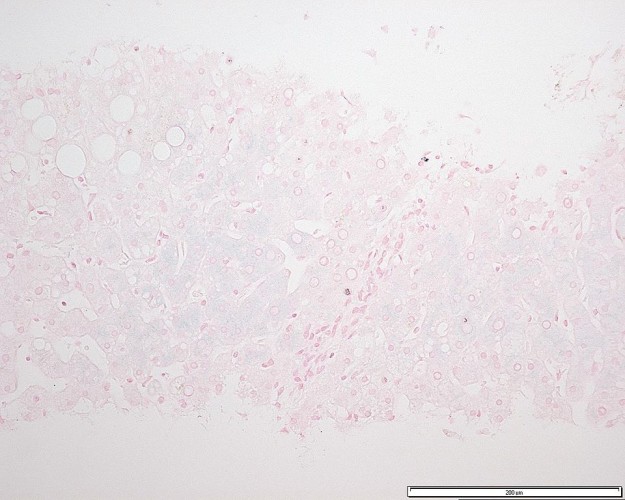 heterozygous genetic Hemochromatosis