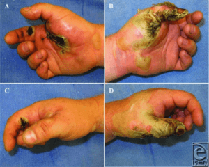 high-voltage electrical injury high-voltage electrical injury