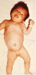 hypotonic posture, myxedematous facies, macroglossia, and umbilical hernia