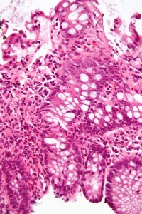 inflammatory bowel disease micrograph