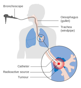 internal radiotherapy for lung cancer