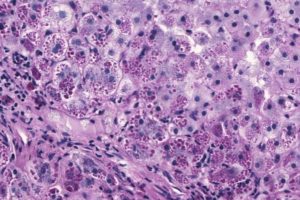 liver biopsy from a patient with alpha-1 antitrypsin deficiency