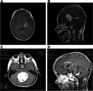 locations of pilocytic astrocytomas