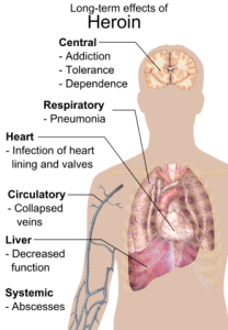 long-term effects of heroine long-term effects of heroine