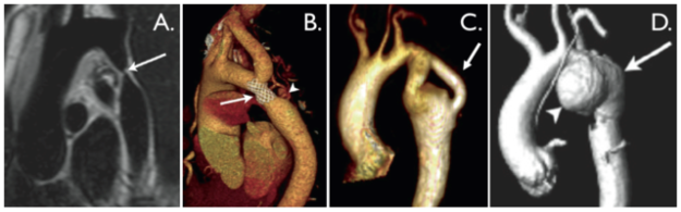 Coarctation-of-the-aorta-cardiac-images