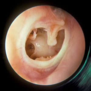 Subtotal perforation of the right tympanic membrane