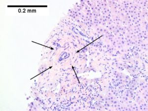 Primary sclerosing cholangitis in patient with history of ulcerative colitis