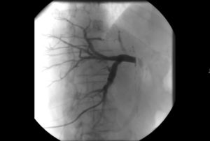 biliary stenosis