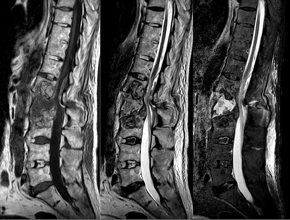 Ankylosing Spondylitis (Bechterew's Disease) Online Medical Library