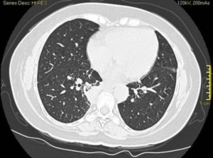 lung nodules